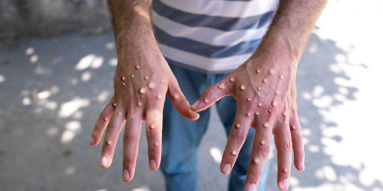 m cicegi virusu yayilmaya devam ediyor vaka sayisi 467ye yukseldi yKqxI4Rl