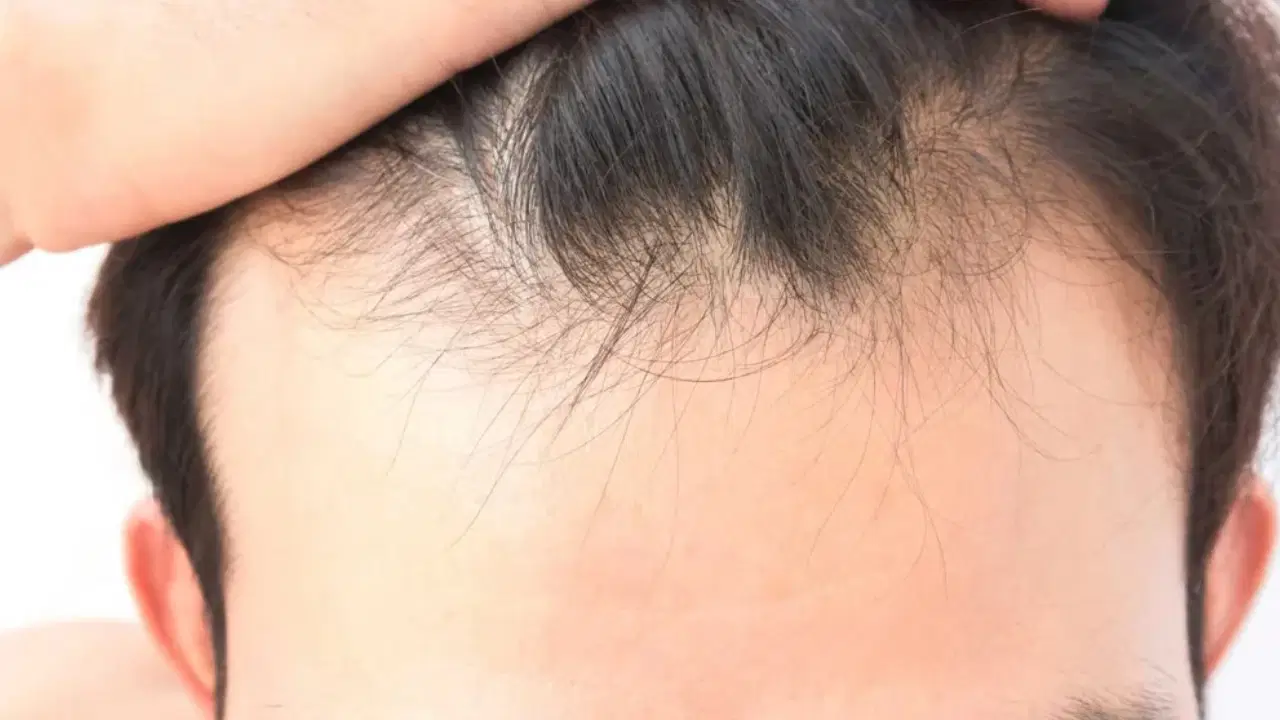 sac dokulmesinde gizli neden vitamin ve mineral eksikligi ne kadar etkili Z9AeQ8PO.jpg